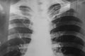 X-ray of a human chest or lungs radiography shot.