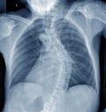 X-ray of the human chest organs, C-shaped scoliotic deformity of the spinal column Royalty Free Stock Photo