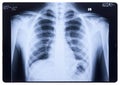 X-ray, Human Chest