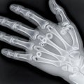X-ray of a Human Hand with Foreign Objects in Joints Royalty Free Stock Photo
