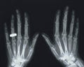 X-ray of human hands