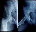 X-Ray human hip Royalty Free Stock Photo