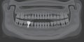 X-ray of human jaw with normal teeth and dental implant. Radiograph with prosthesis in gum Royalty Free Stock Photo