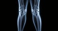 An X-ray of a human knee joint, highlighting the complexity of its structure Royalty Free Stock Photo