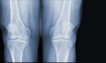 X-ray of human knee normal joints and ligaments Medical image concept Royalty Free Stock Photo