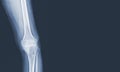 x-ray of human knee severe Osteoarthritis of the Knee normal ligaments Medical image concept Royalty Free Stock Photo