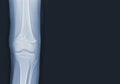 X-ray of human knee showing closed fracture,right distal femur , normal joints and ligaments Medical image concept Royalty Free Stock Photo