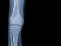 X-ray of human knee showing closed fracture,right distal femur , normal joints and ligaments Medical image concept Royalty Free Stock Photo