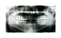 X-ray of Human Mouth with Fillings