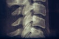 X-ray of human neck, vertebra or spine Royalty Free Stock Photo