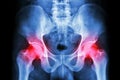 X-ray human's pelvis and arthritis at both hip joint (Gout , Rheumatoid)