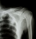 X-ray of human shoulder.