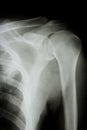 X-ray of human shoulder.