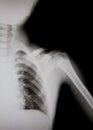 X-ray of human shoulder (broken shoulder) Royalty Free Stock Photo