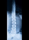 X-ray of human spinal column