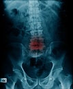 Compression fracture of l-spine Royalty Free Stock Photo