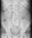 X-ray image of abdomen in supine position for doctor diagnostic