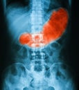 X-ray image of abdomen, supine position,