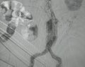 X-ray image. Angiogram of right common iliac artery after aortic stent graft