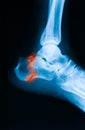 X-ray image of ankle joint, lateral view.