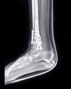 X-ray image of ankle joint showing surgical treatment by internal fixation with plate and screw