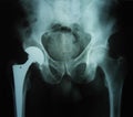 X-ray image of an artificial hip Royalty Free Stock Photo