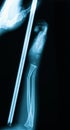 X-ray image of baby forearm fracture.