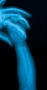 X-ray image of baby hand fracture.