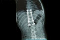 X-ray image of back pain with implant