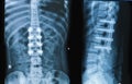 X-ray image of back pain show spinal column with implant fusion