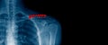 x-ray image and banner design of shoulder in blue tone Royalty Free Stock Photo