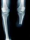 BKA x-ray image