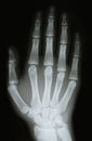 X-ray image of the bones of arm Royalty Free Stock Photo