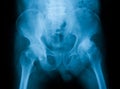 X-ray image of both hip, AP view. Royalty Free Stock Photo