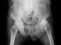 X-ray image of both hip, AP view. Royalty Free Stock Photo