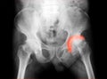 X-ray image of both hip, AP view. Royalty Free Stock Photo