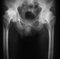 X-ray image of both hip, AP view. Royalty Free Stock Photo