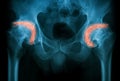 X-ray image of both hip, AP view. Royalty Free Stock Photo