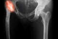 X-ray image of both hip
