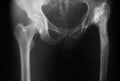 X-ray image of both hip, AP view. Royalty Free Stock Photo