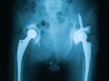 X-ray image of both hip, showing hip replacement Royalty Free Stock Photo