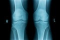 X-ray image of both human knee Royalty Free Stock Photo