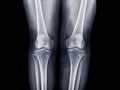 x-ray image of both knee AP view for detect Osteoarthritis of Knee joint .