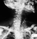 X-ray image of broken cervical spine. Royalty Free Stock Photo