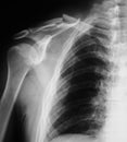 X-ray image of broken clavicle.