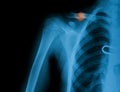 X-ray image of broken clavicle.