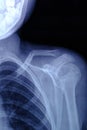 X-ray image broken collarbone person