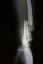 X-ray image of broken forearm, AP and lateral view show fracture