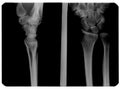 X-ray image of broken hand Royalty Free Stock Photo