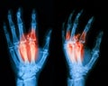 X-ray image of broken hand, lateral view.